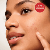Acne Patches 36 Dots with 1% Salicylic Acid