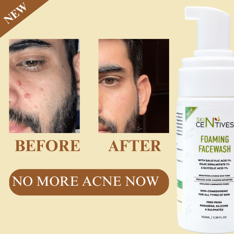 Skin Centives Face Wash for Oily Skin – 1% Salicylic Acid , 1% Glycolic Acid & 1% Kojic Acid – 100ML